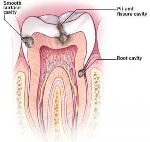 de7_cavities-300x283