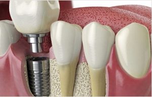 Dental Implants Cherry Creek, Denver