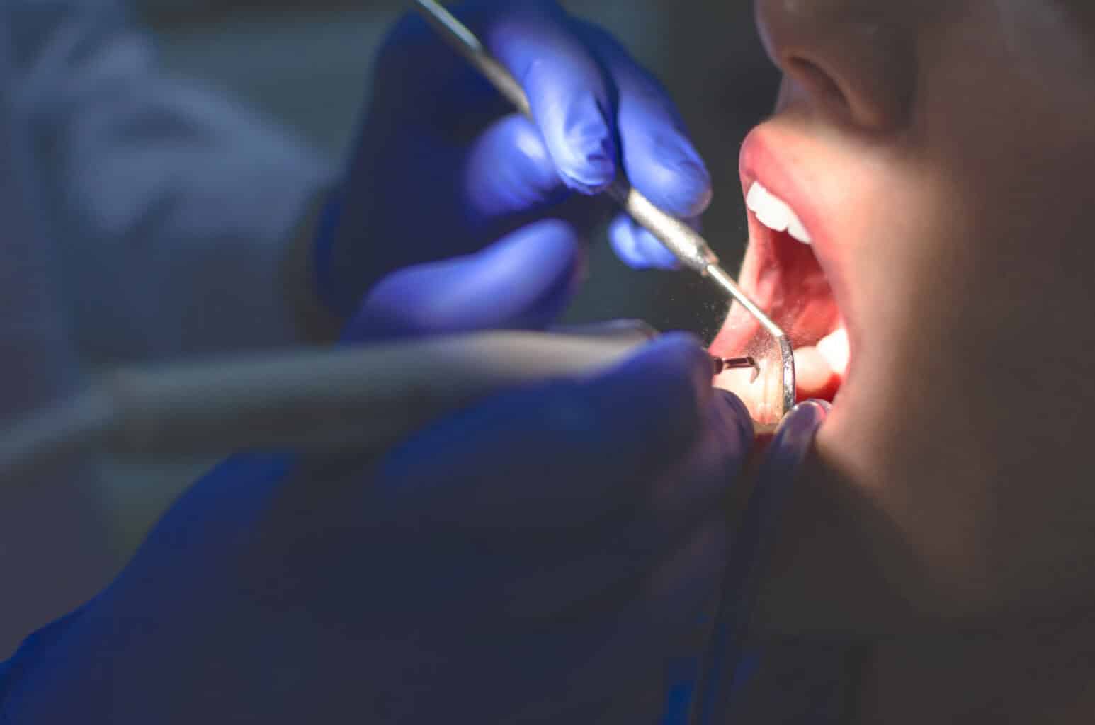 Deep Teeth Cleaning