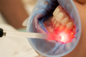 Red light therapy for oral health Denver